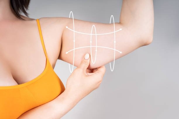 Exploring Arm Fat Reduction Treatments