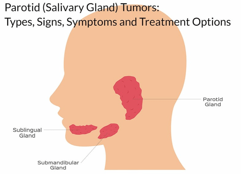 rare tumors