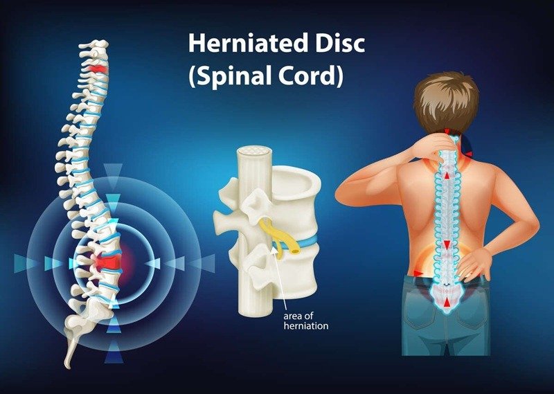 Understanding Herniated Discs: Symptoms, Treatments, and Healing Process